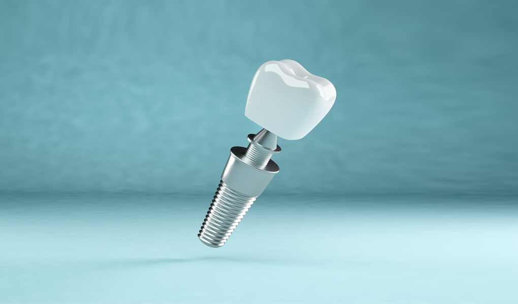Dental Implants Cardiff